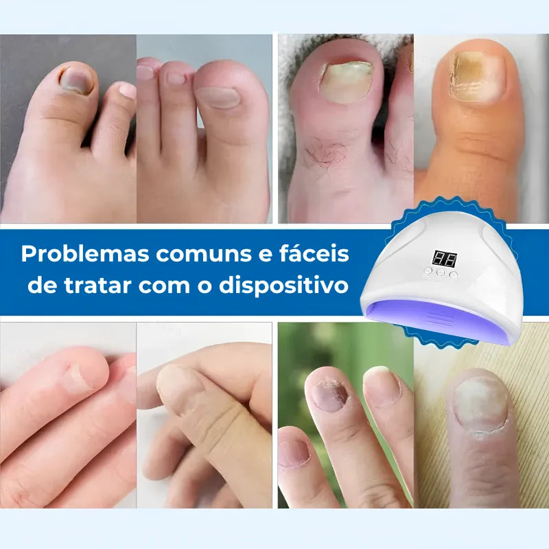 Dispositivo Laser Funcional Para Unhas