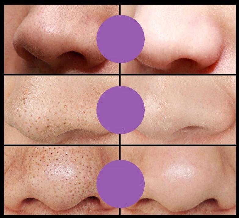 Máscara Facial Anti-Cravos Auquest