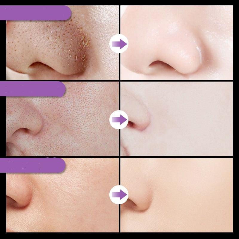 Máscara Facial Anti-Cravos Auquest